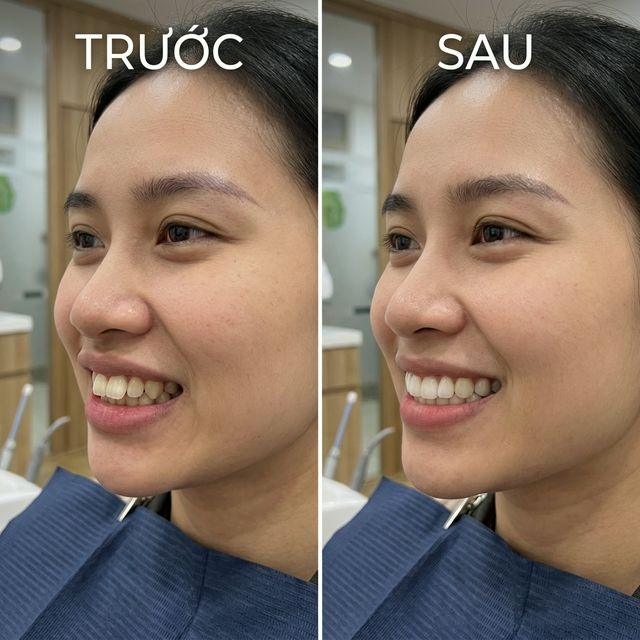 Invisalign 18 tháng – Hô nặng thành nụ cười rạng rỡ – Nha Khoa Limia