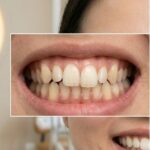 Trước điều trị