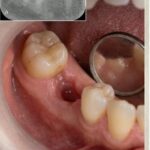 Trước điều trị