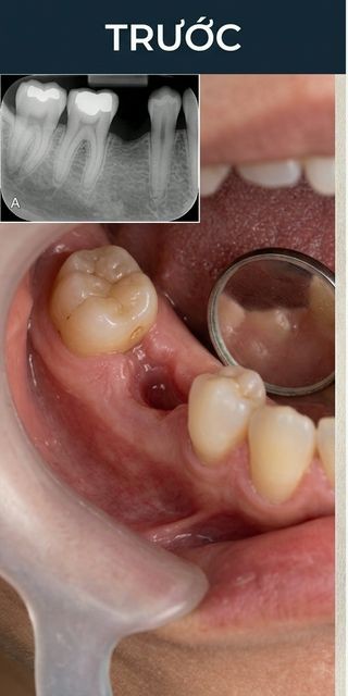Trước điều trị – Nha Khoa Limia