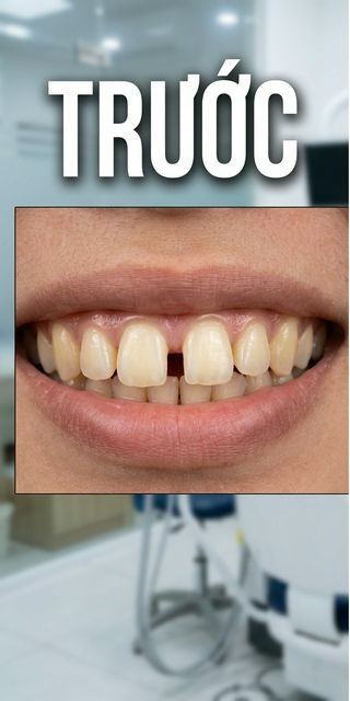 Trước điều trị – Nha Khoa Limia