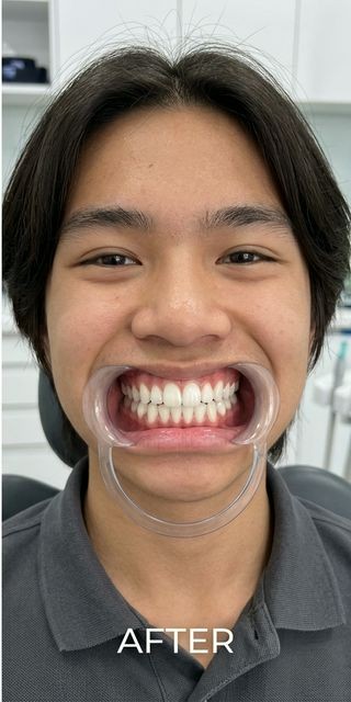 Zoom Whitening – Vàng do cà phê – 60 phút — Sau điều trị