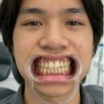 Trước điều trị