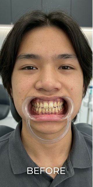 Trước điều trị – Nha Khoa Limia