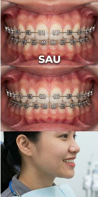 Niềng mắc cài – Móm nhẹ – 22 tháng — Sau điều trị