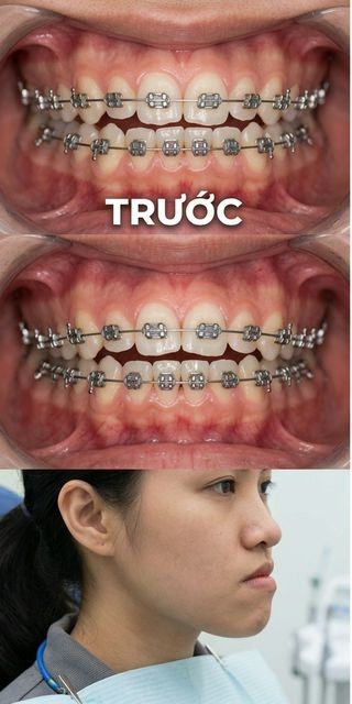 Trước điều trị – Nha Khoa Limia