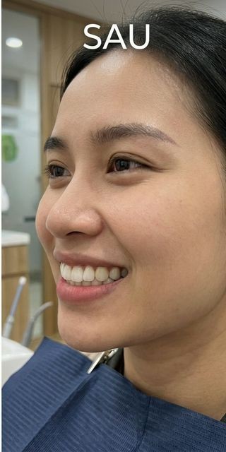 Invisalign 18 tháng – Hô nặng thành nụ cười rạng rỡ — Sau điều trị