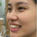 Trước điều trị