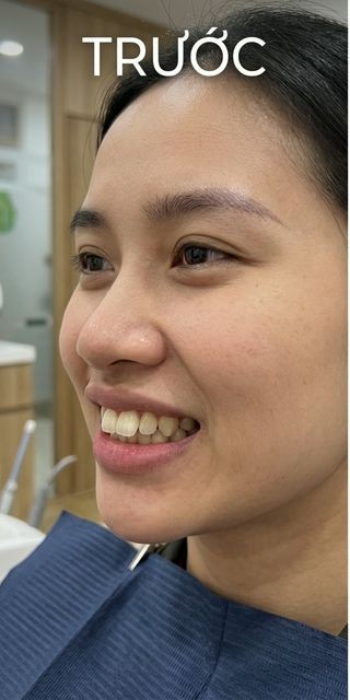 Trước điều trị – Nha Khoa Limia
