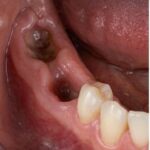 Trước điều trị