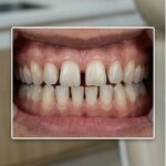 Trước điều trị