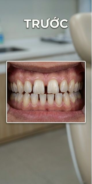 Trước điều trị – Nha Khoa Limia