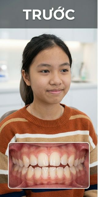 Trước điều trị – Nha Khoa Limia