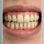 Trước điều trị