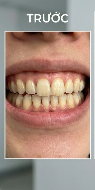 Trước điều trị – Nha Khoa Limia